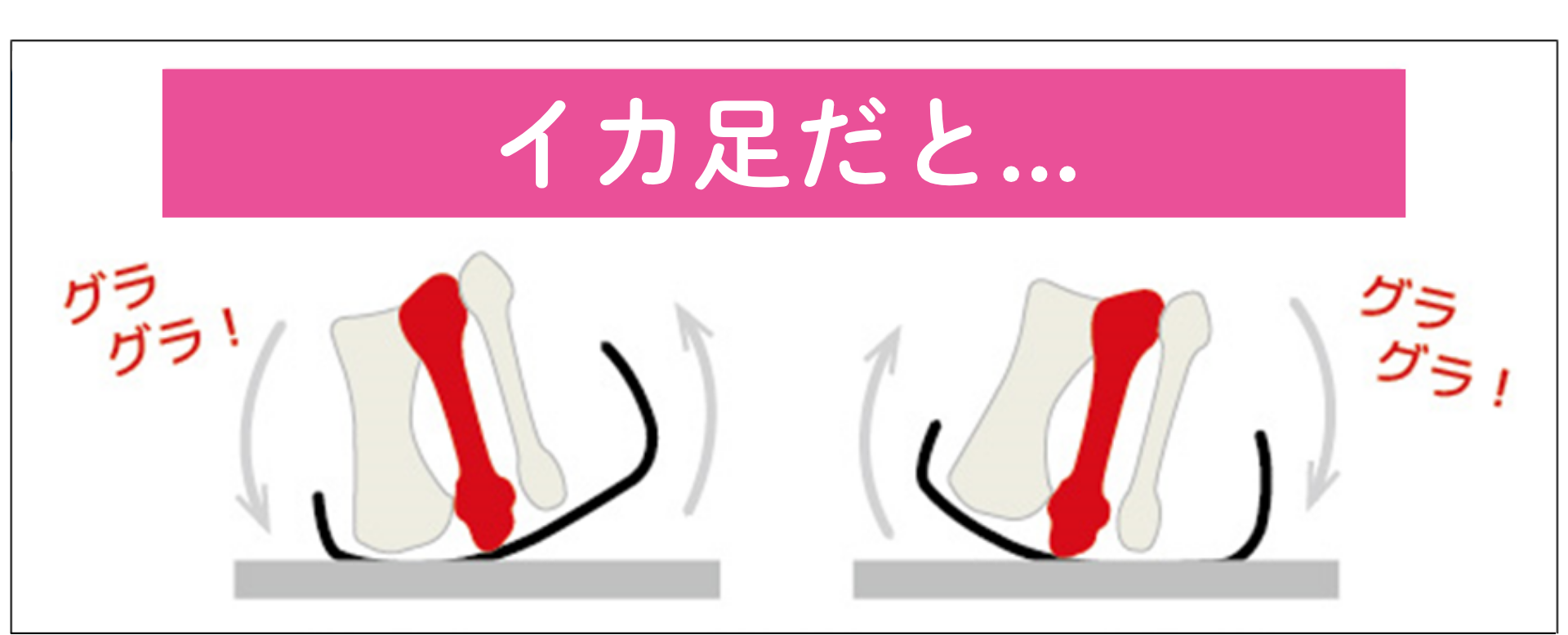 イカ足問題を説明する図。中足骨の先端のばらつきから、前足部の荷重バランスが崩れ、ルルベでぐらつきやすくなる流れ。